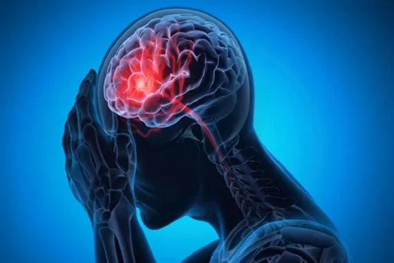 طرق "أساسية" لتقليل خطر الإصابة بالسكتة الدماغية