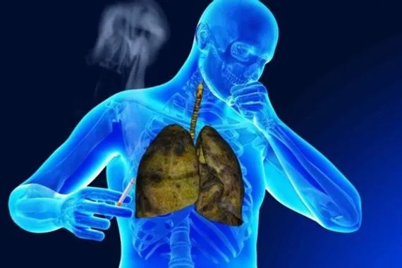 دراسة تكشف عن دواء واعد لعلاج الانسداد الرئوي