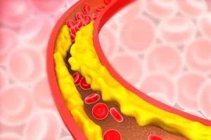 دراسة دهون خفية تهدد الشرايين حتى لدى النحفاء