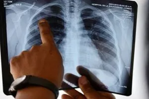 الذكاء الاصطناعي سرّع الكشف الصحة العراق تفوّق على النسبة العالمية لعلاج التدرن وبلغت 94