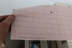 تطوير نماذج قلبية ثلاثية الأبعاد تفتح آفاقًا جديدة لفهم الرجفان الأذيني وكالة الانباء العراقية واع