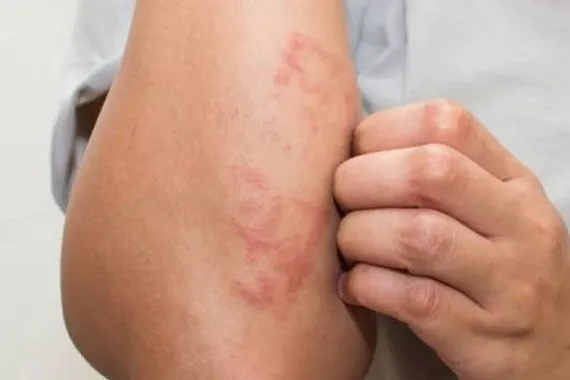 اكتشاف صلة بين التسمير الصناعي وسرطان الجلد