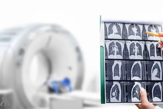 دراسة جديدة ترصد آلية خفية تعزز عدوانية سرطان الرئة وكالة الانباء العراقية واع