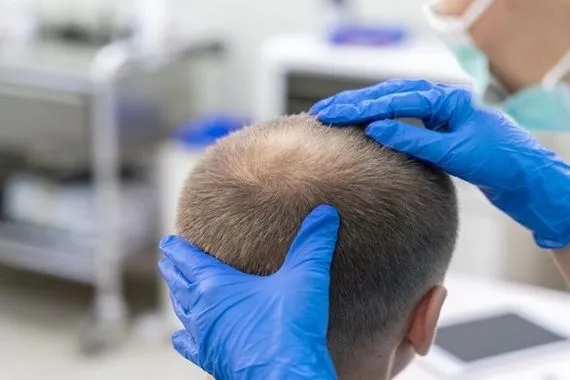 اخصائية تفند معتقدات شائعة عن تساقط الشعر