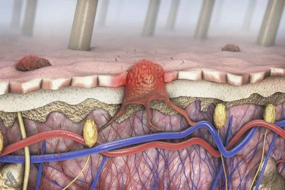 مكان غير متوقع قد يظهر فيه سرطان الجلد الميلانيني وكالة الانباء العراقية واع