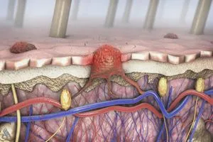 مكان غير متوقع قد يظهر فيه سرطان الجلد الميلانيني وكالة الانباء العراقية واع