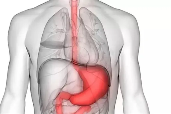 دراسة تكشف كيفية التخلص من حرقة المعدة دون أدوية